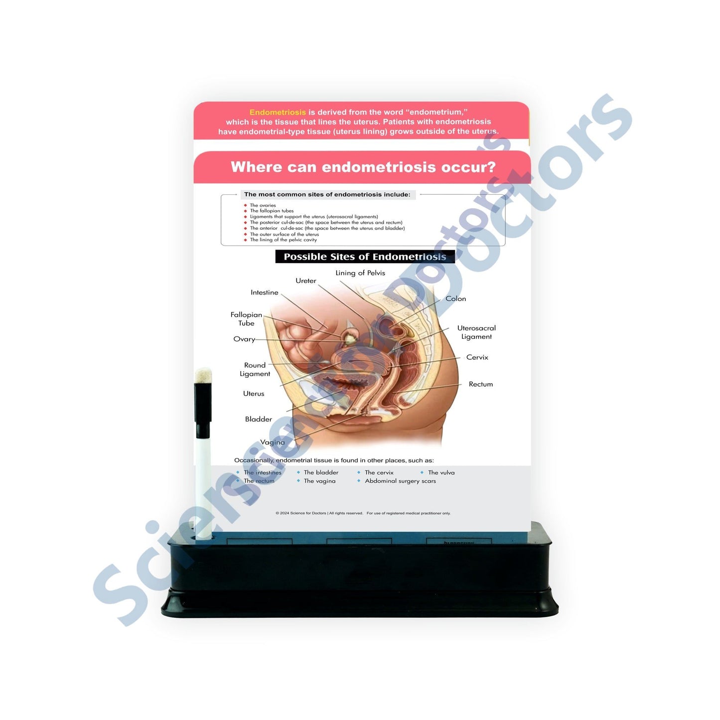 Where can endometriosis occur: 2 Slide on stand