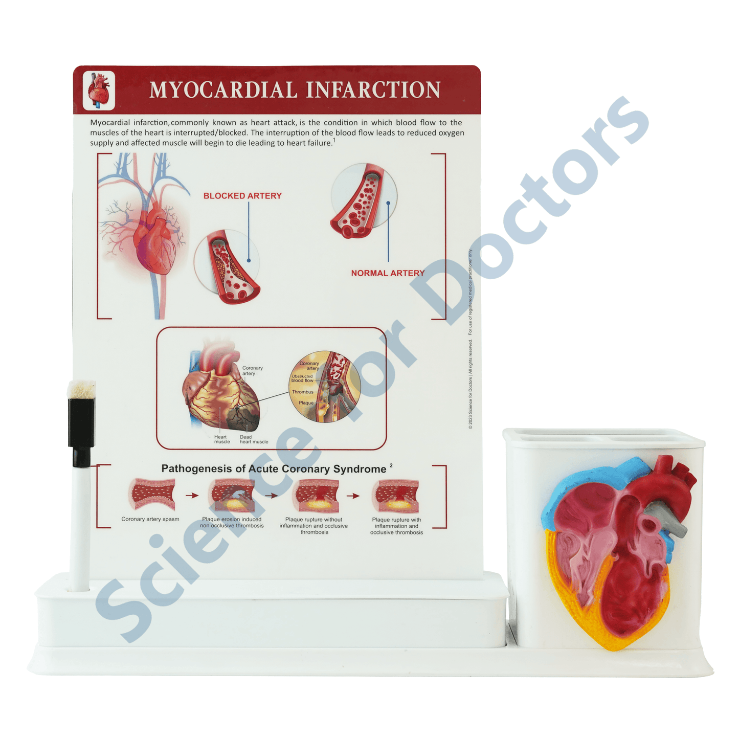 Myocardial Infraction : 1 Slide Write and wipe with anatomical model on stationery stand