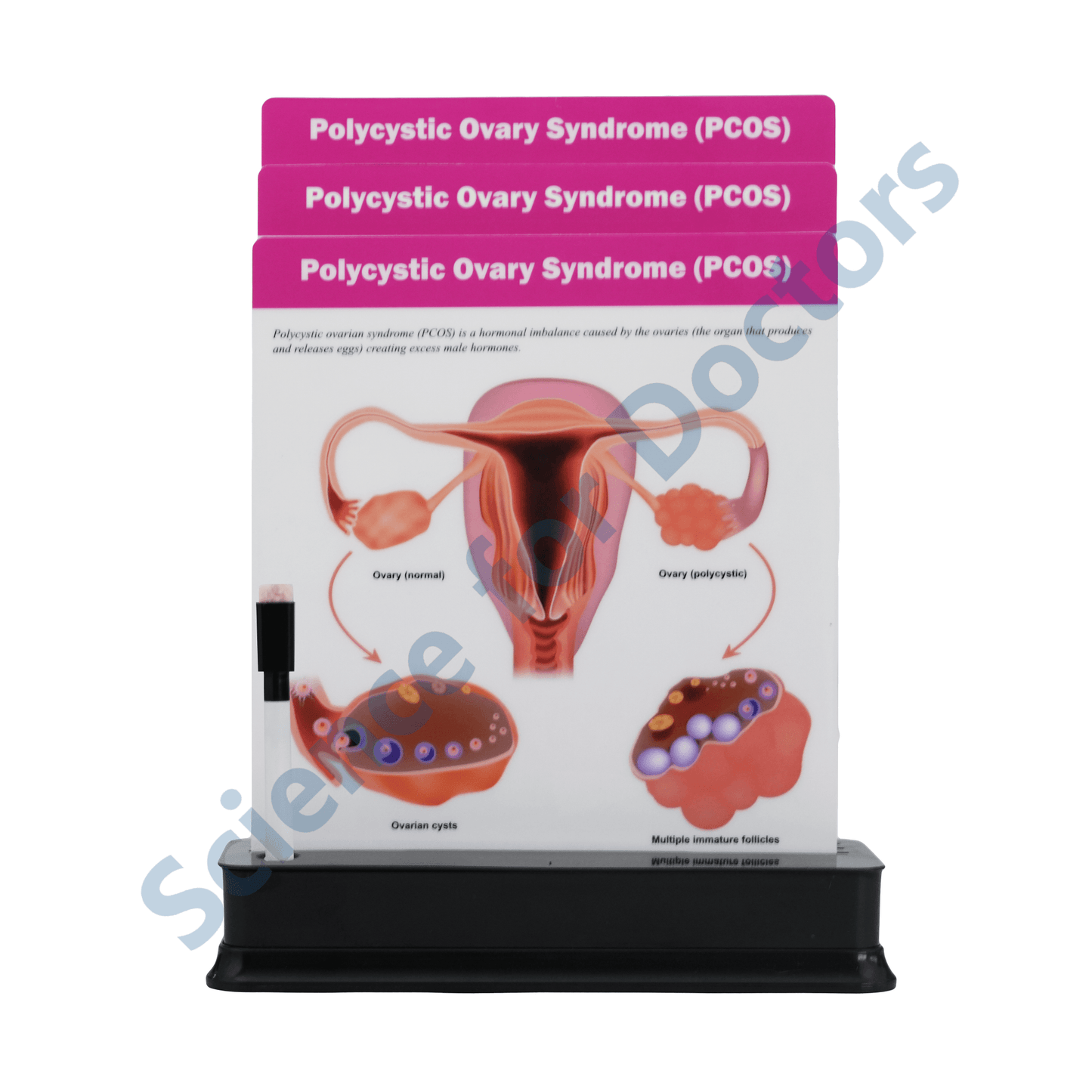 PCOS( Polycystic Ovary Syndrome): 3 slide on stand