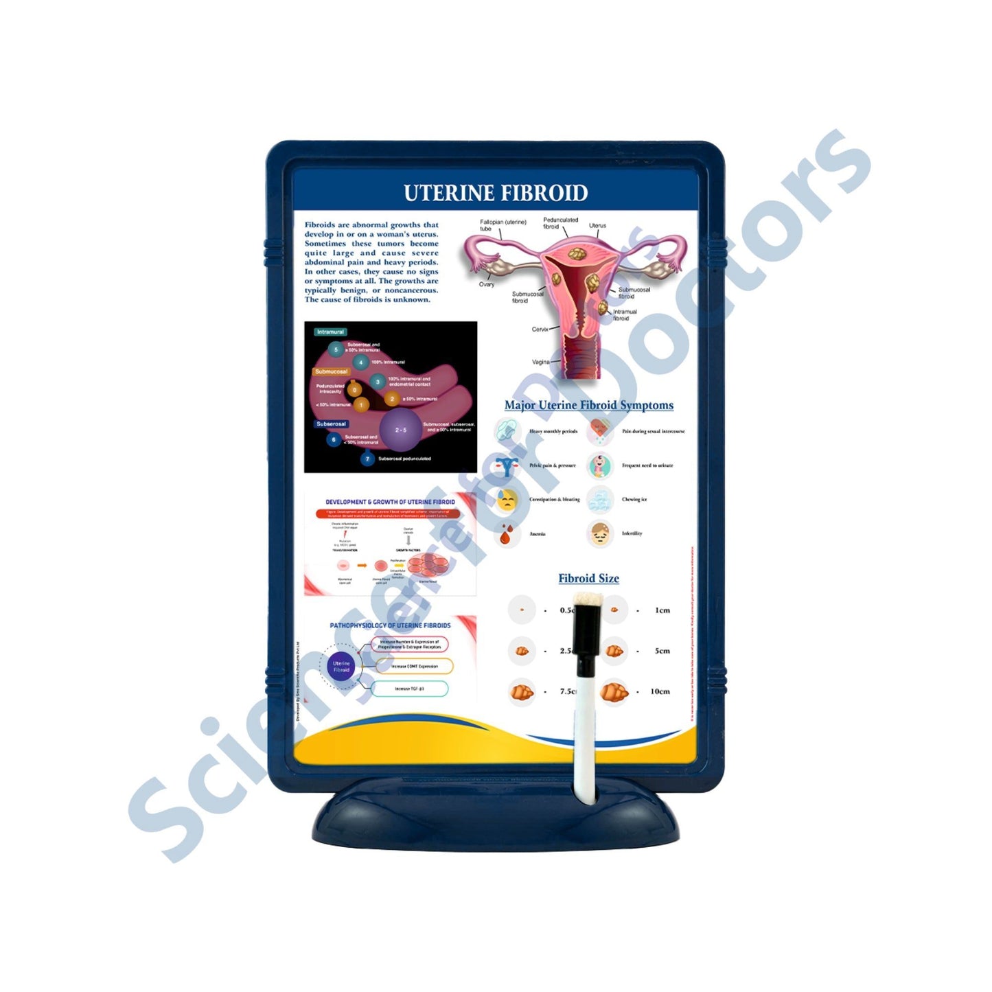 Uterine Fibroid: The Frame Write & Wipe