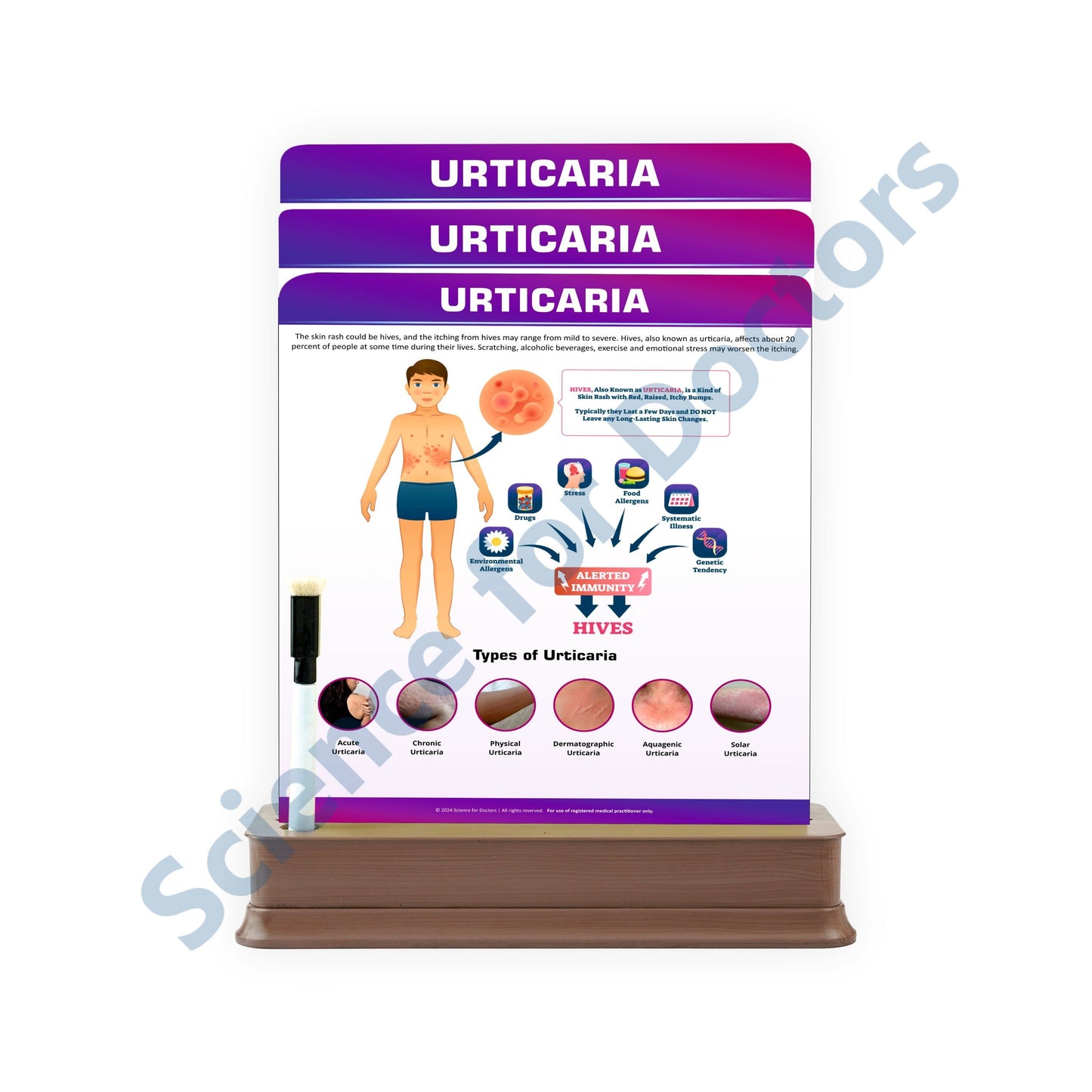 Urticaria: 3 Slides on Stand