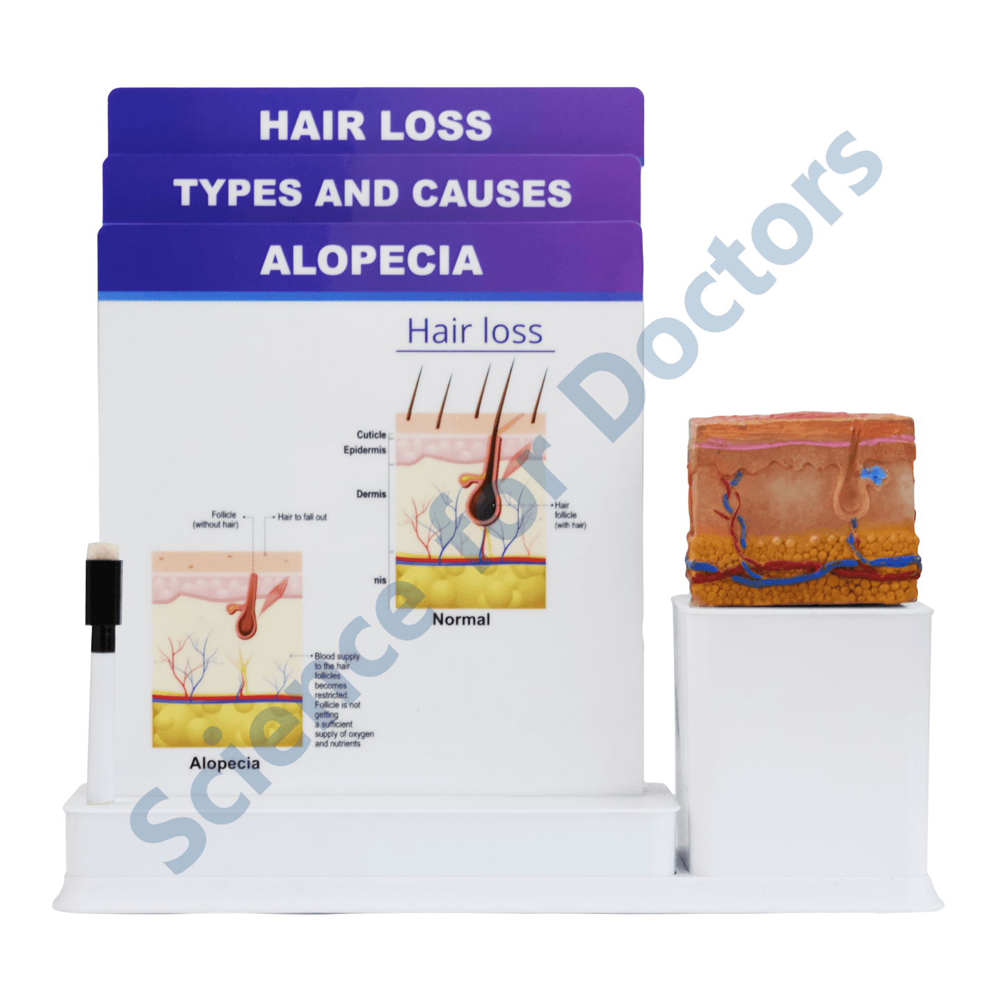 Alopecia: 3 Slide Write and Wipe with Anatomical Model on Stand