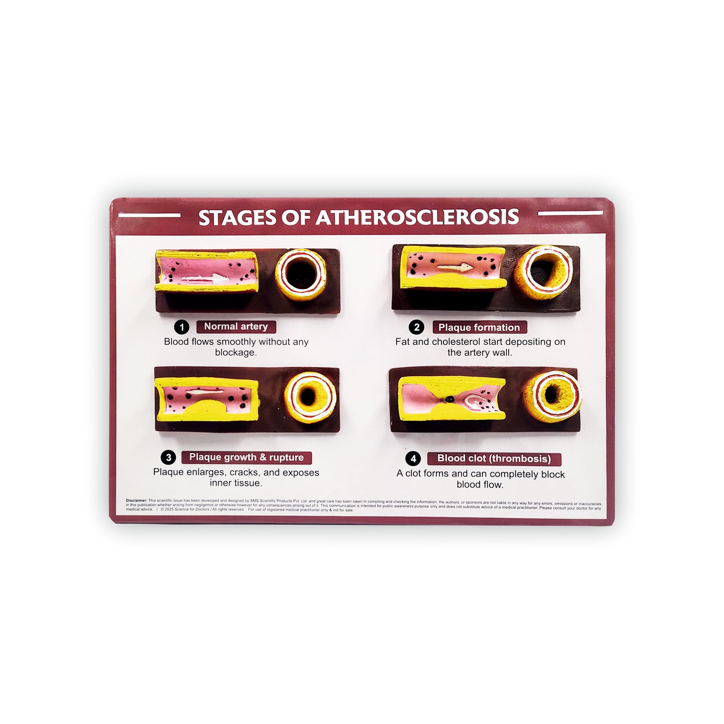 3D Therapy Board - Stages of Atherosclerosis