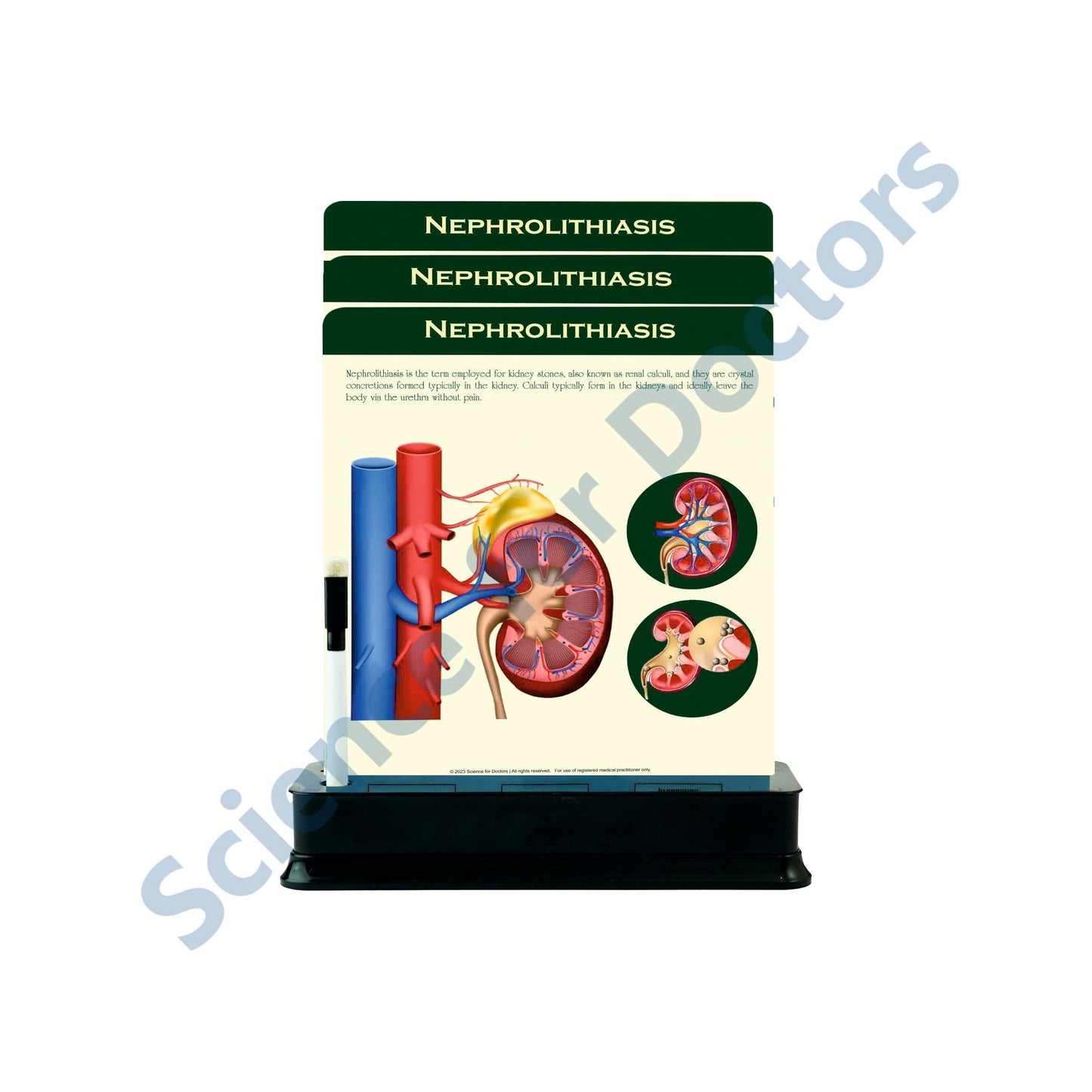 Nephrolithiasis: 3 Slides on stand