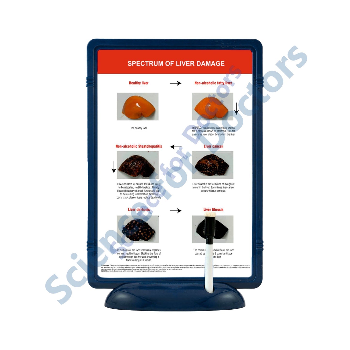 Spectrum of Liver Damage: The Frame Write & Wipe