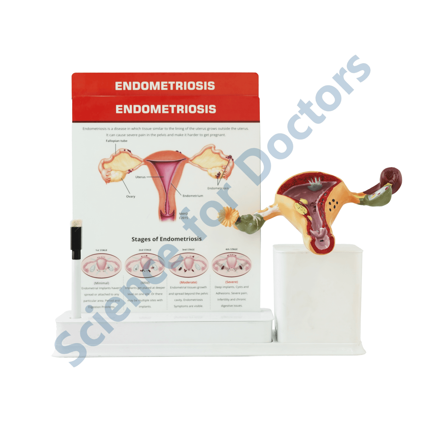 Endometriosis : 2 slide Write and Wipe with Anatomical Model