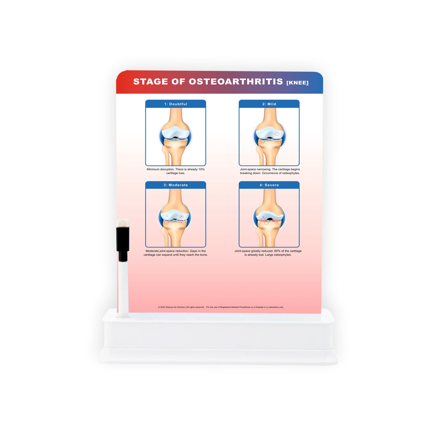 STAGE OF OSTEOARTHRITIS: 1 Slide on stand