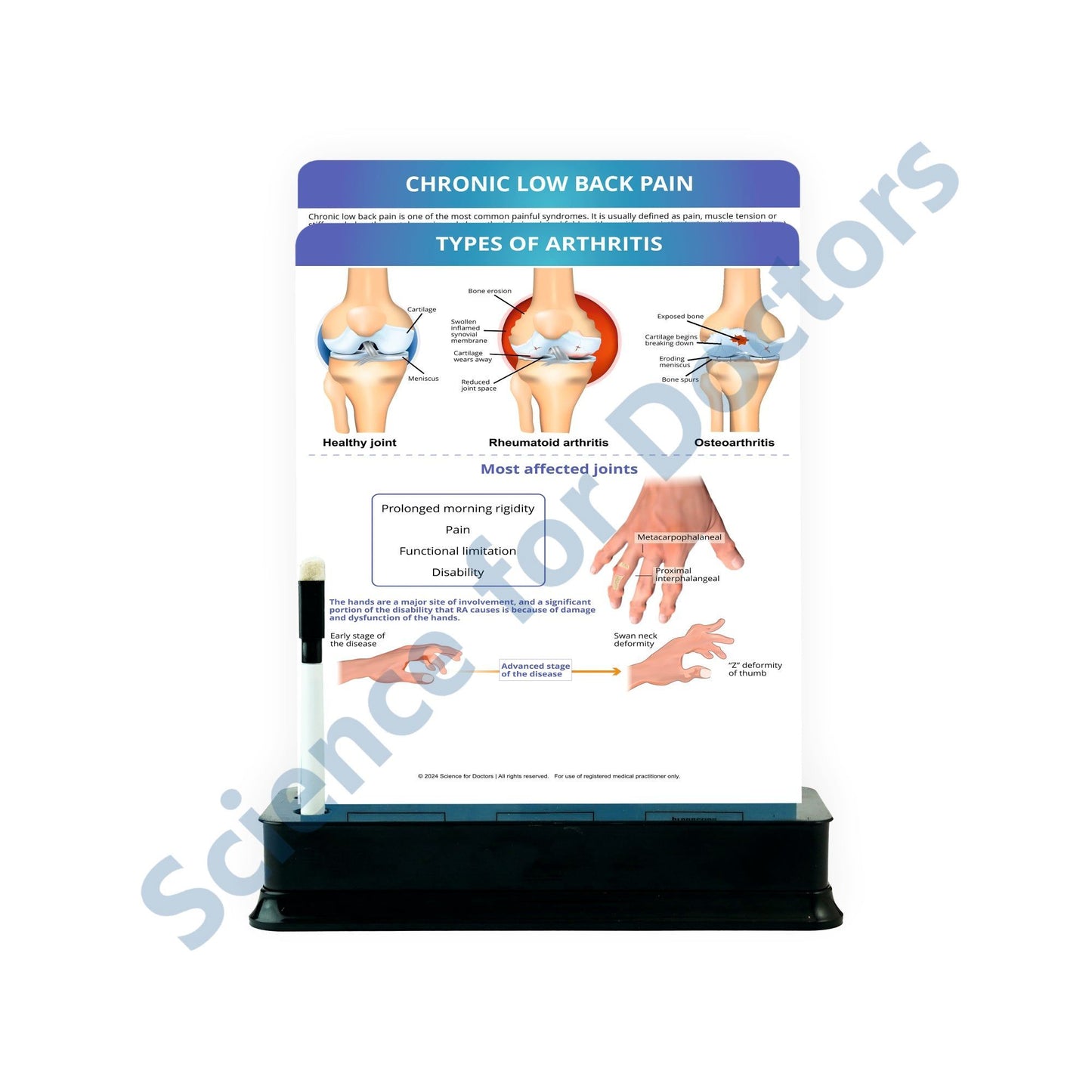 Types of Arthritis: 2 Slides on stand