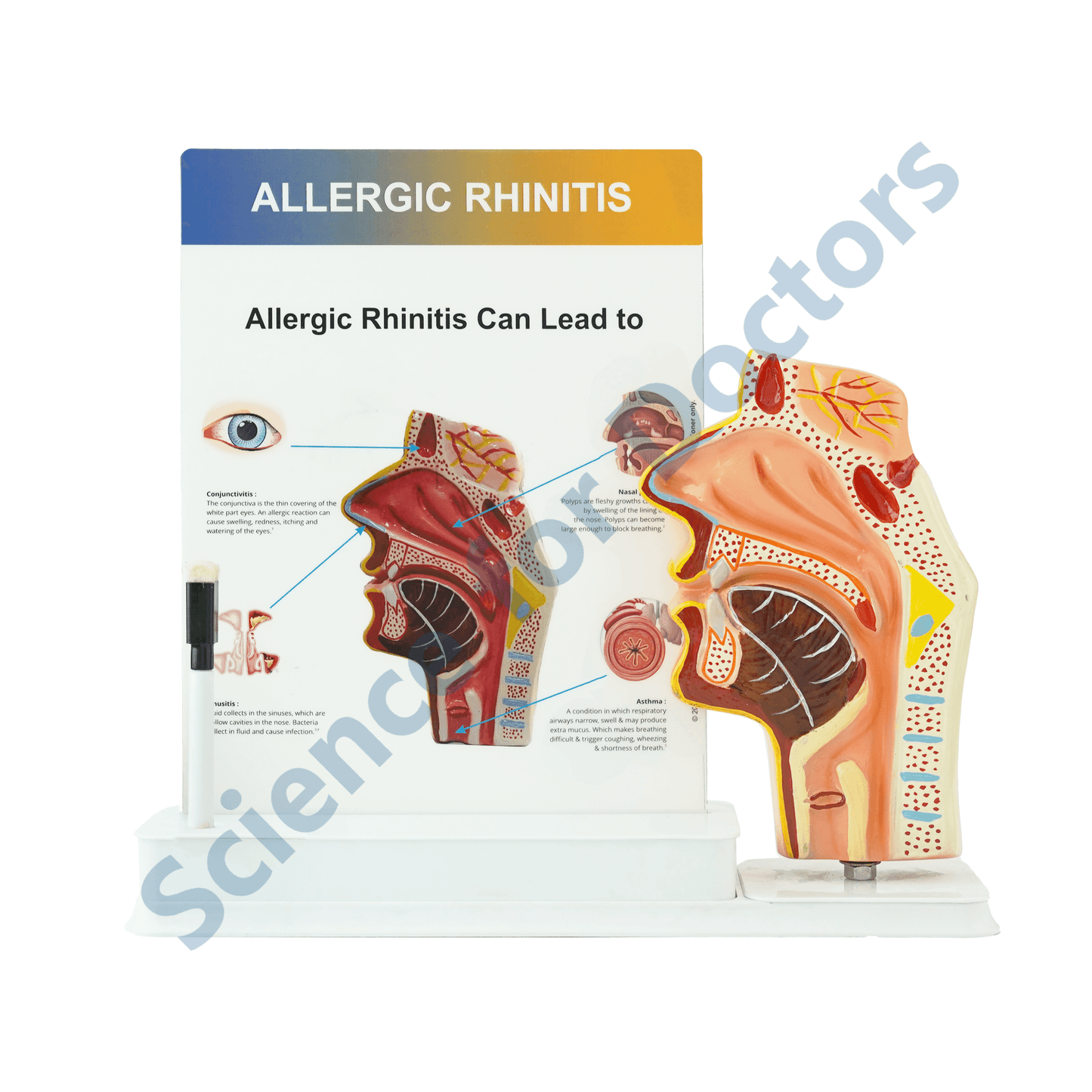 Allergic Rhinitis : 1 Slide write and wipe with anatomical model on stand