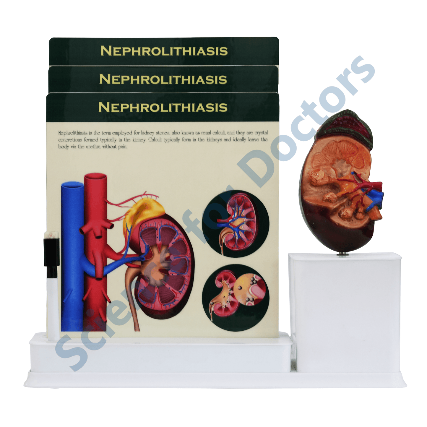 Nephrolithiasis : 3 Slide Write and Wipe with Anatomical Model on Stand