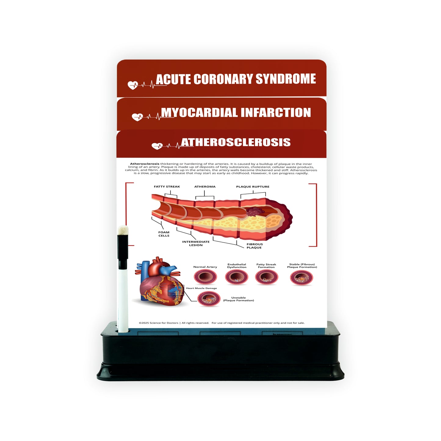 Atherosclerosis: 3 Slides on Stand