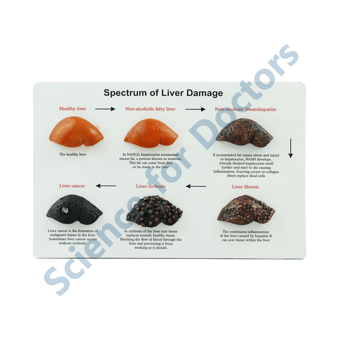 Spectrum of Liver Damage: 3d therapy Board