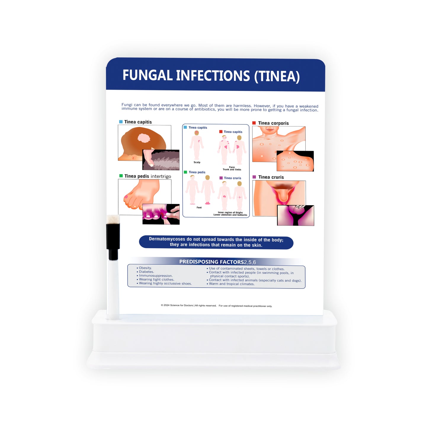 Fungal Infections (Tinea): 1 Slide with Stand