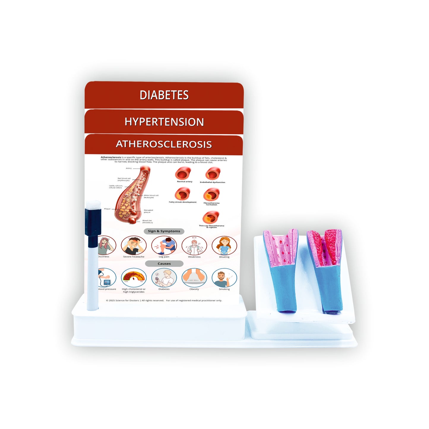 Atherosclerosis: Smart -3 Slides Write & Wipe With Anatomical Model