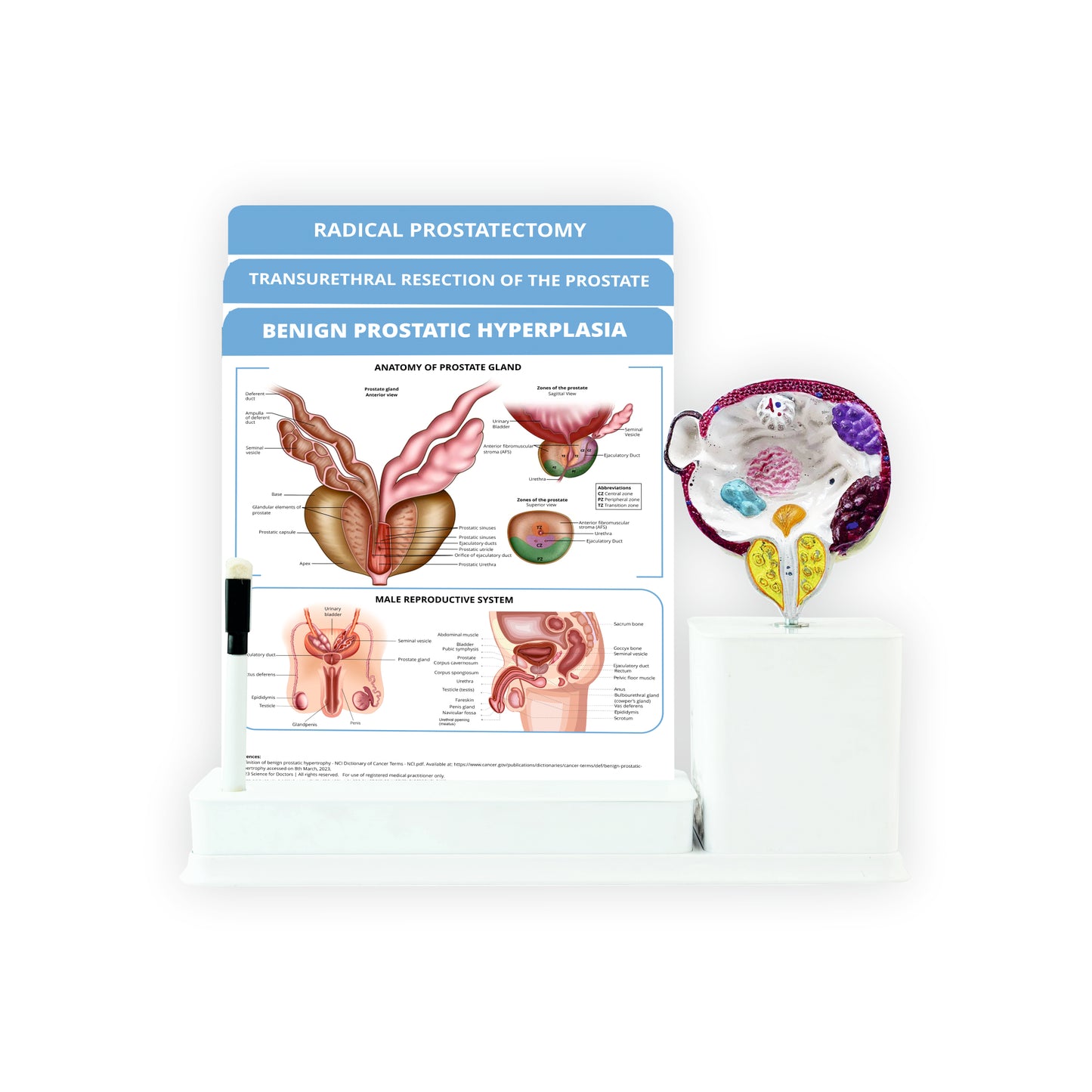 Benign Prostatic Hyperplasia : 3 Slides Write & Wipe With Model On Stand