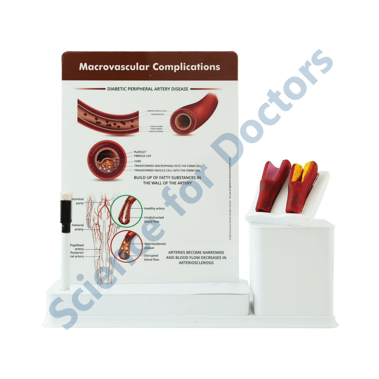 Macrovascular Complications Diabetic Peripheral Artery Disease : 1 Slide write and wipe with anatomical model on stand