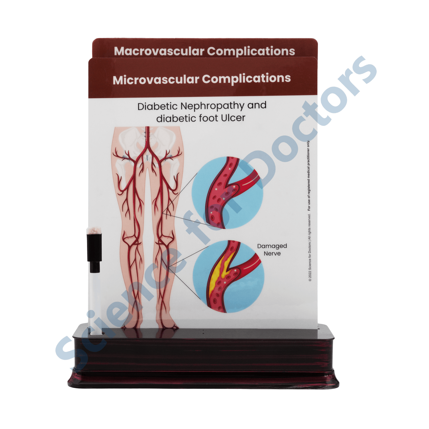 Microvascular Complications: 2 Slide on stand