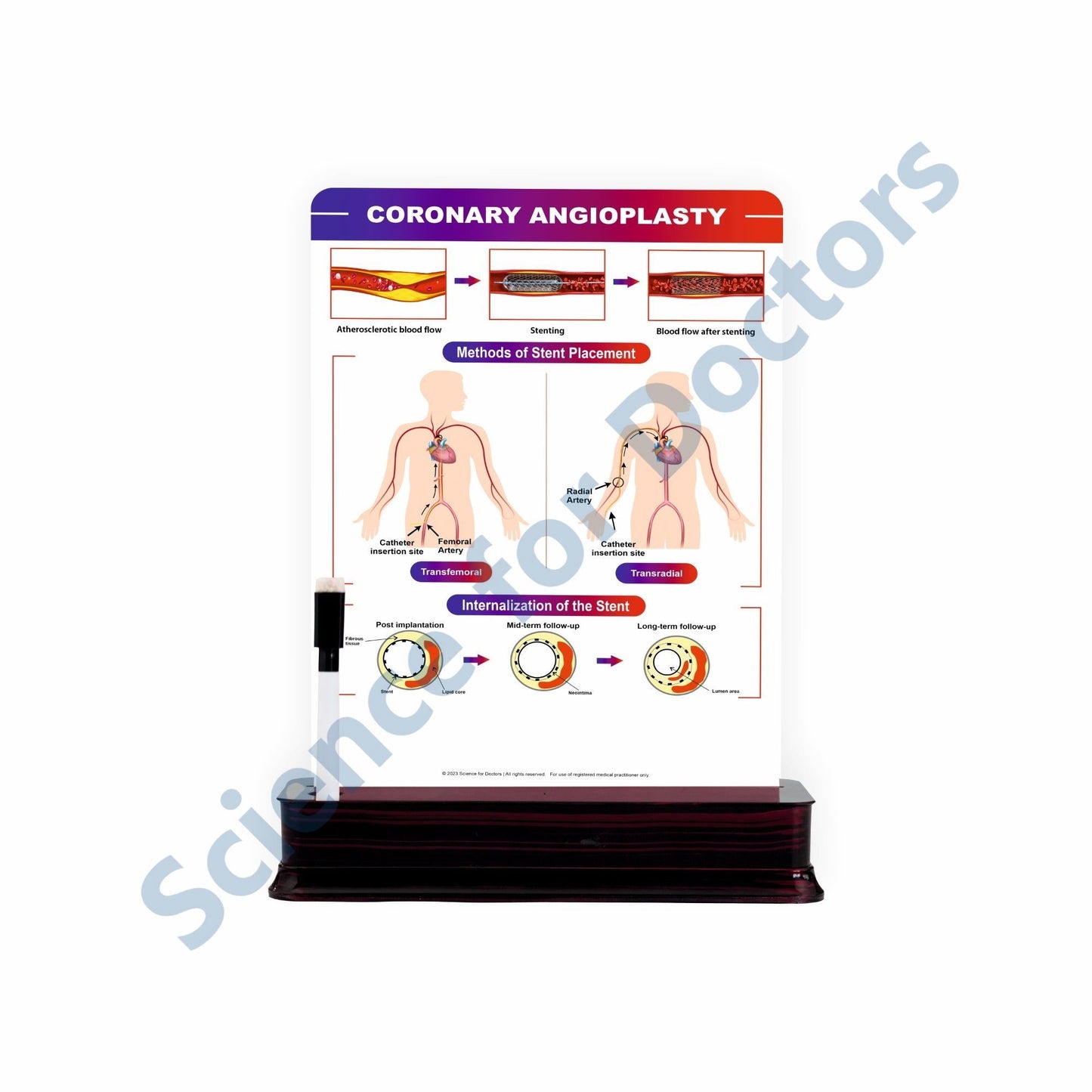 Coronary Angioplasty: 1 Slide on stand