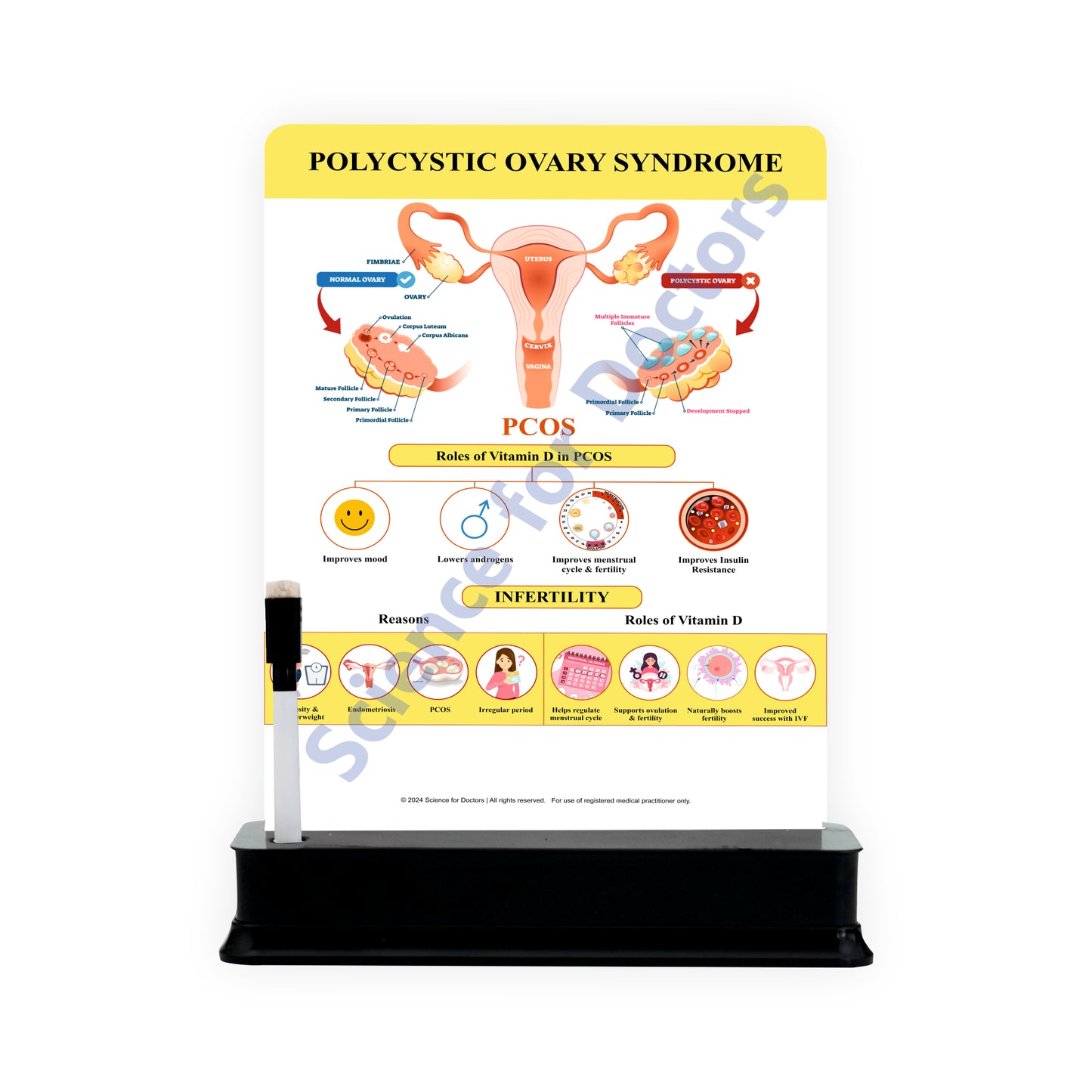 Polycystic Ovary Syndrome: 1 Slide on stand