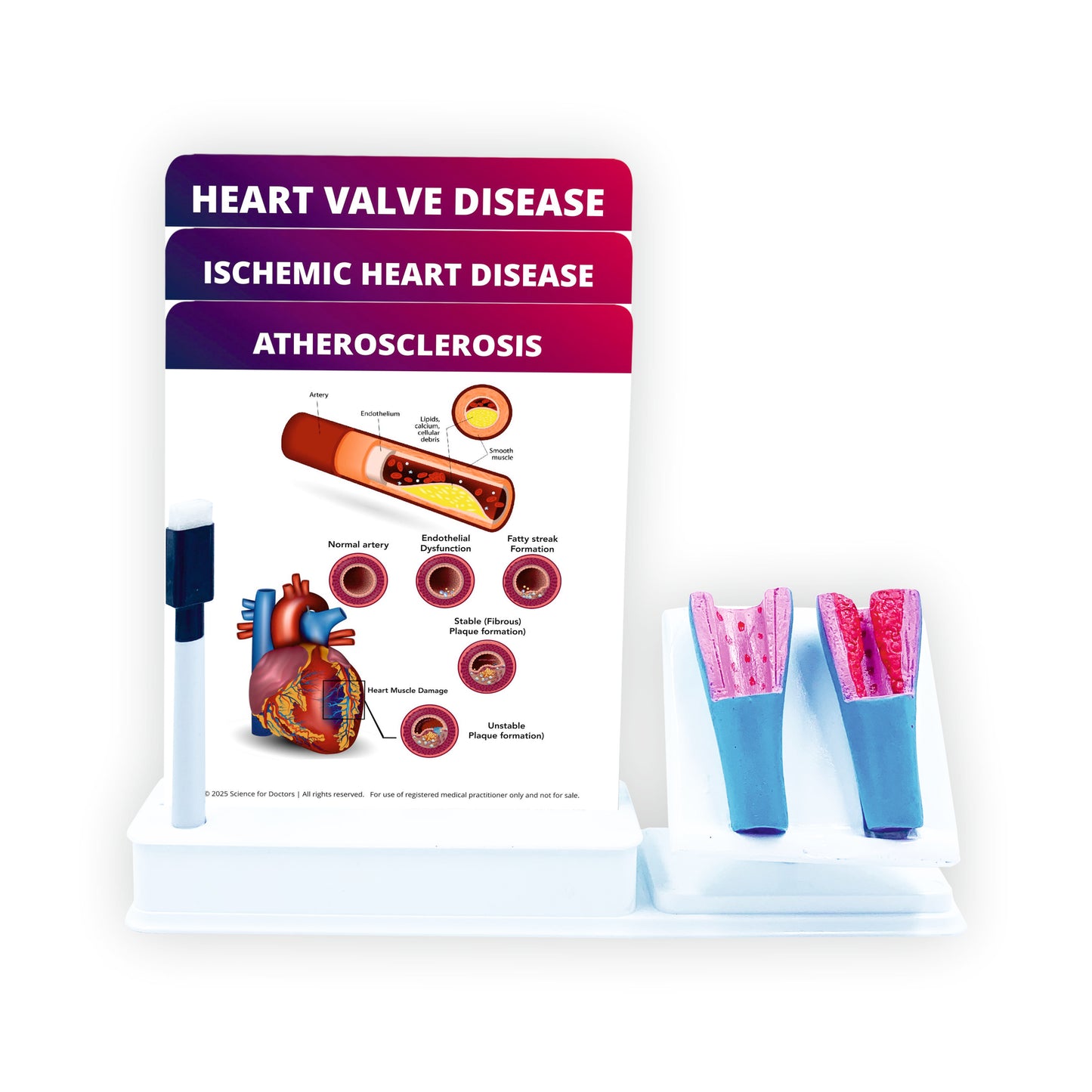 Atherosclerosis: Smart -3 Slides Write & Wipe With Anatomical Model