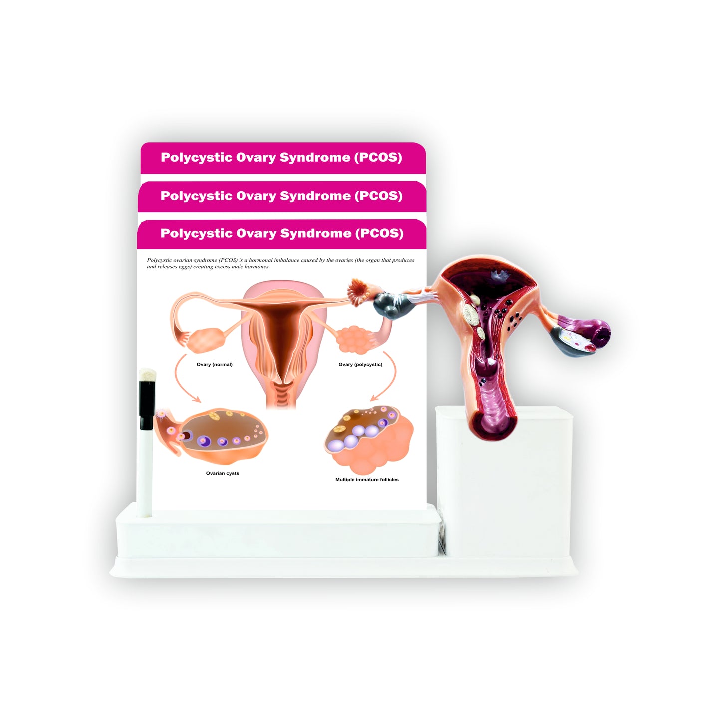 Polycystic Ovary Syndrome (PCOS): 3 Slides Write and Wipe With Model On Stand