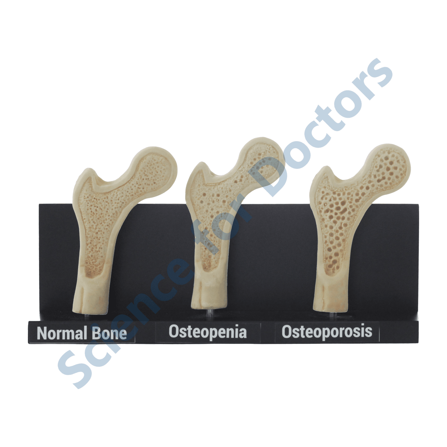 Osteoporosis: 3D Anatomical Models