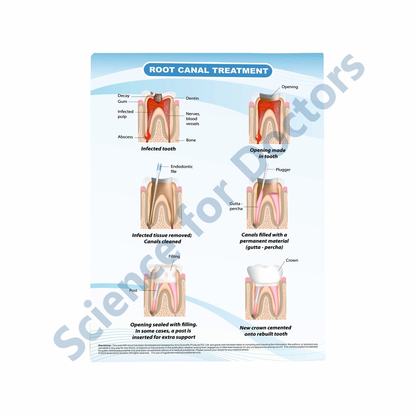 Root Canal Treatment: Therapy Board