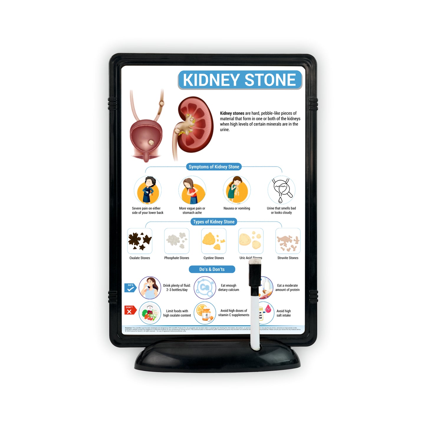Kidney Stone: The Frame Write & Wipe