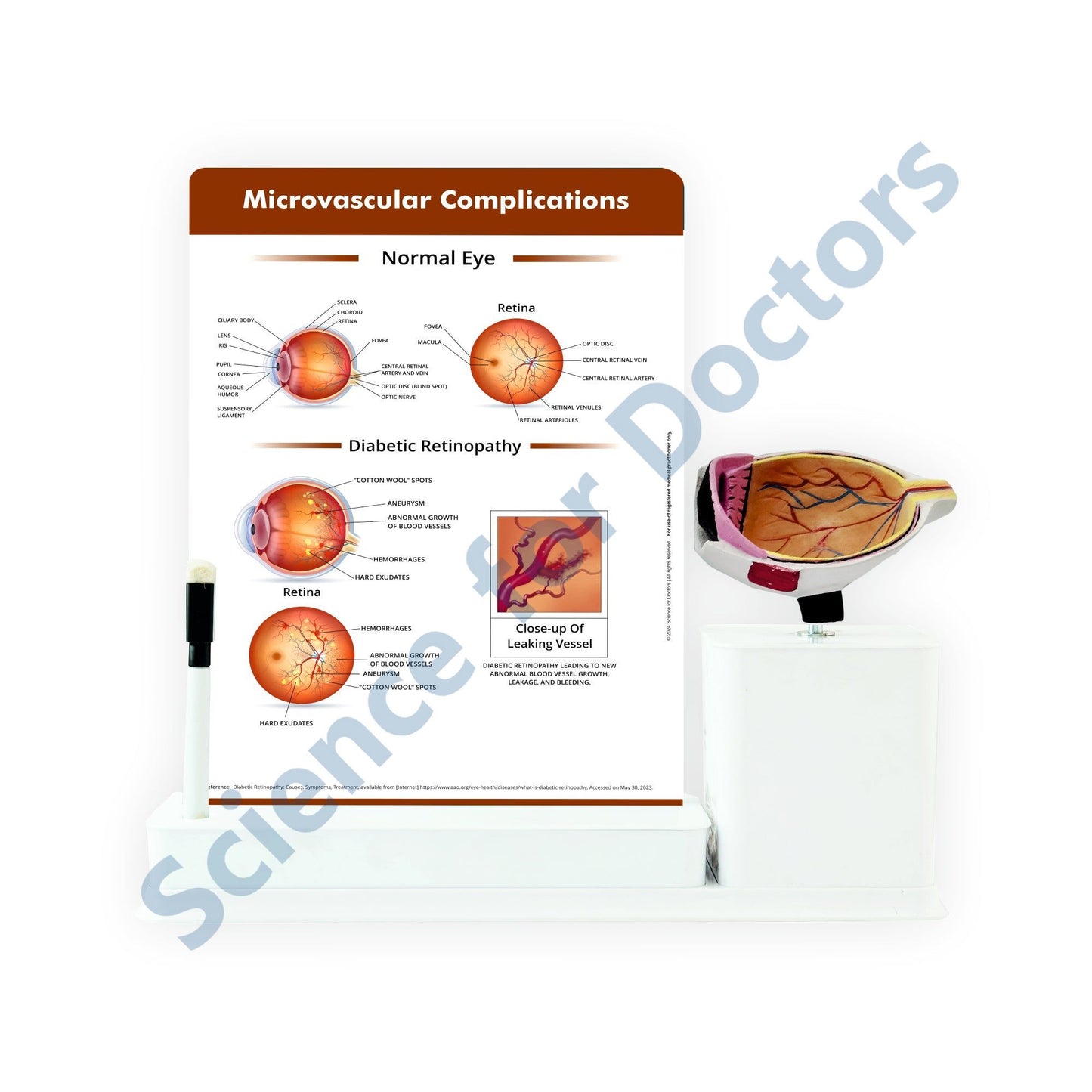 Microvascular complications - Diabetic retinopathy: 1 Slide write and wipe with anatomical model on stand