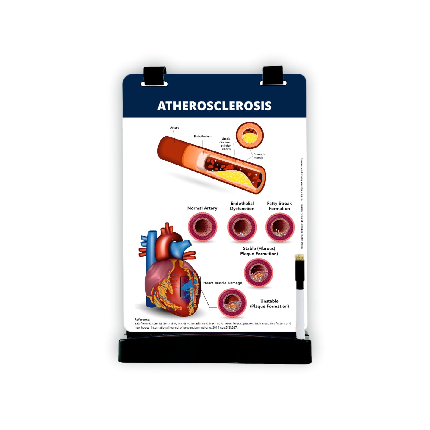 Atherosclerosis: A4 Flip Wipe