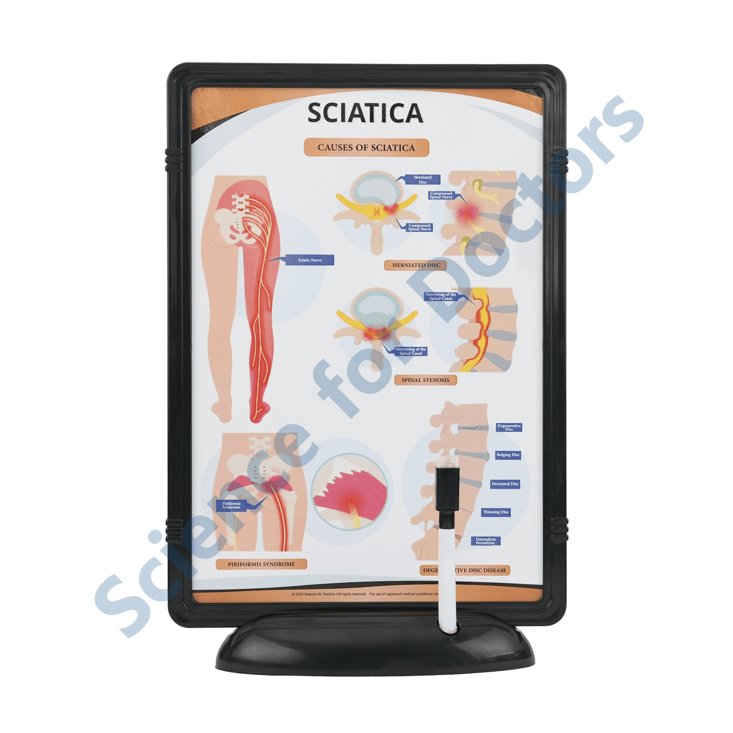 Sciatica: The Frame Write and Wipe