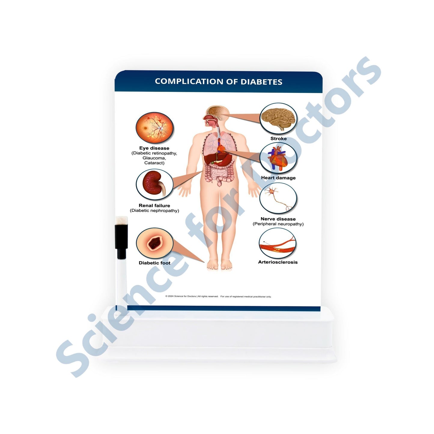 Complication of Diabetes: 1 Slide on stand