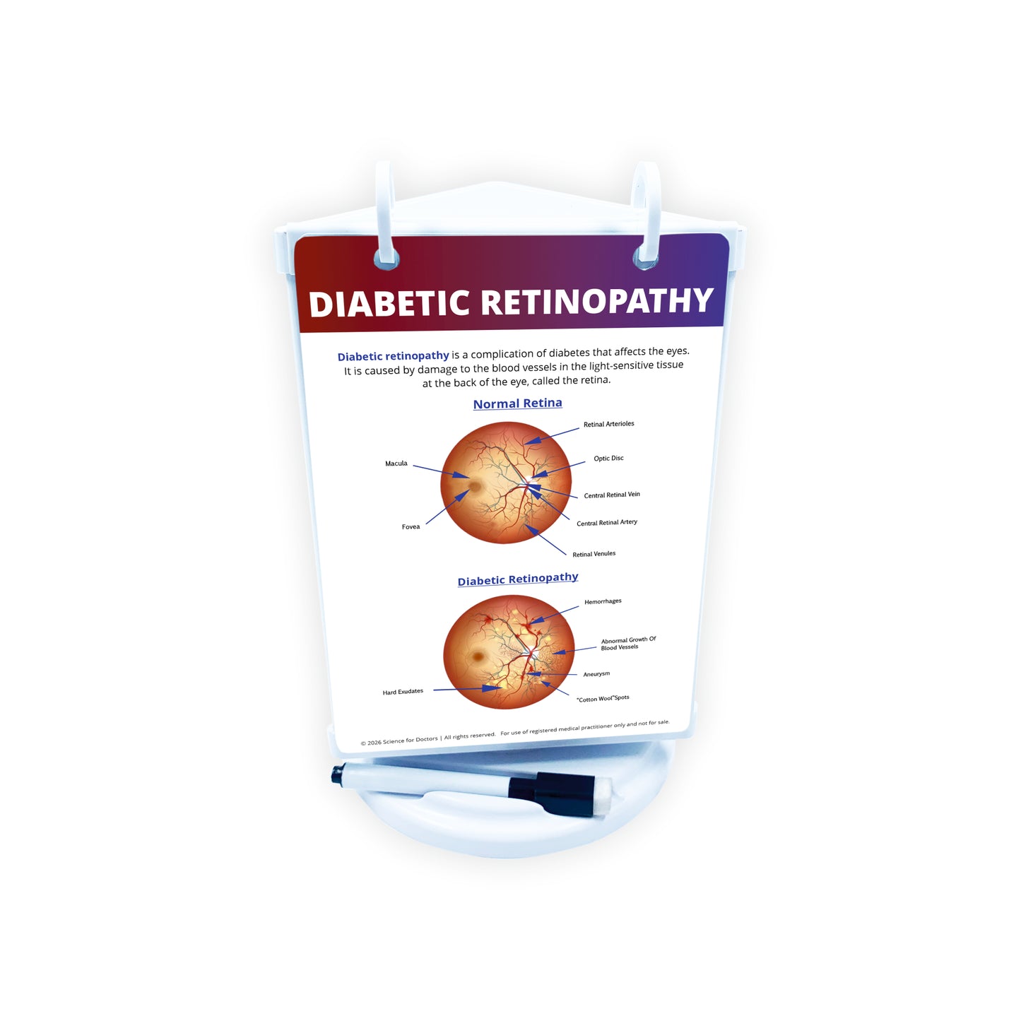 ROTRI - V WITH FLIP WIPES ON TOP  -  DIABETIC RETINOPATHY