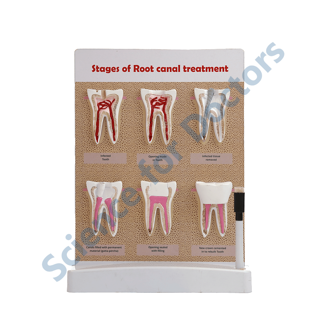 Stages of root canal treatment: 3D Therapy Board On Stand