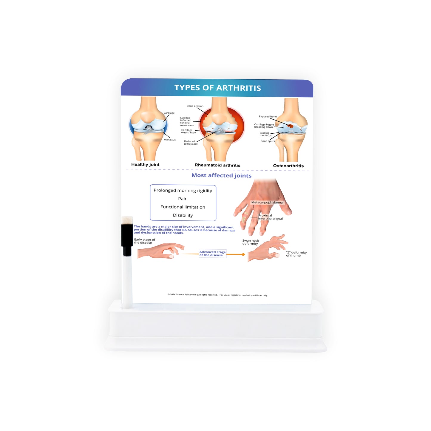 Types of Arthritis: 1 Slide on stand