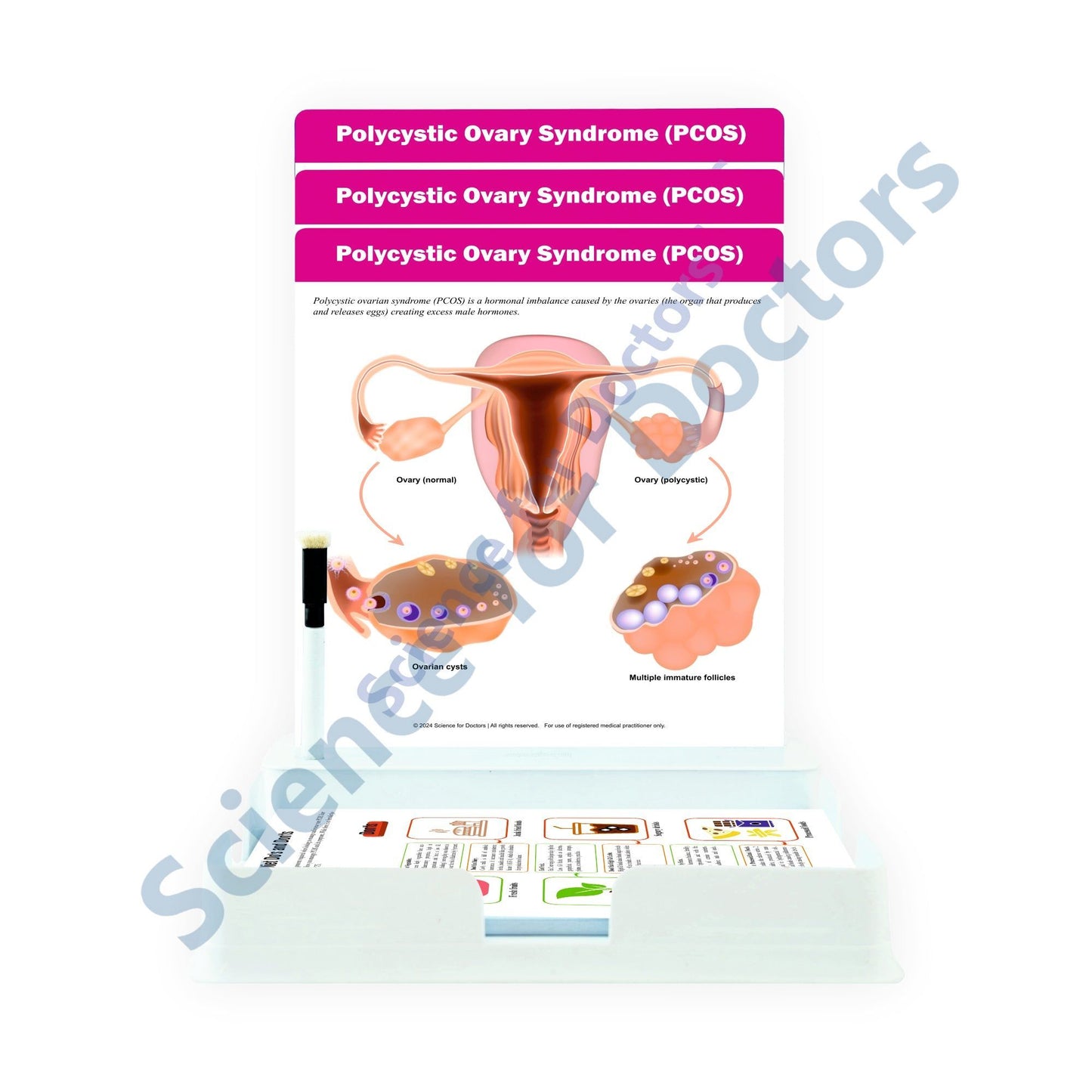 Polycystic Ovary Syndrome (PCOS): 3 Slides Patient Leaflet Tray