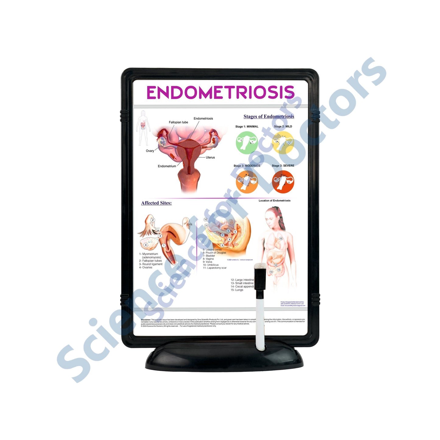 Endometriosis: The Frame Write & Wipe