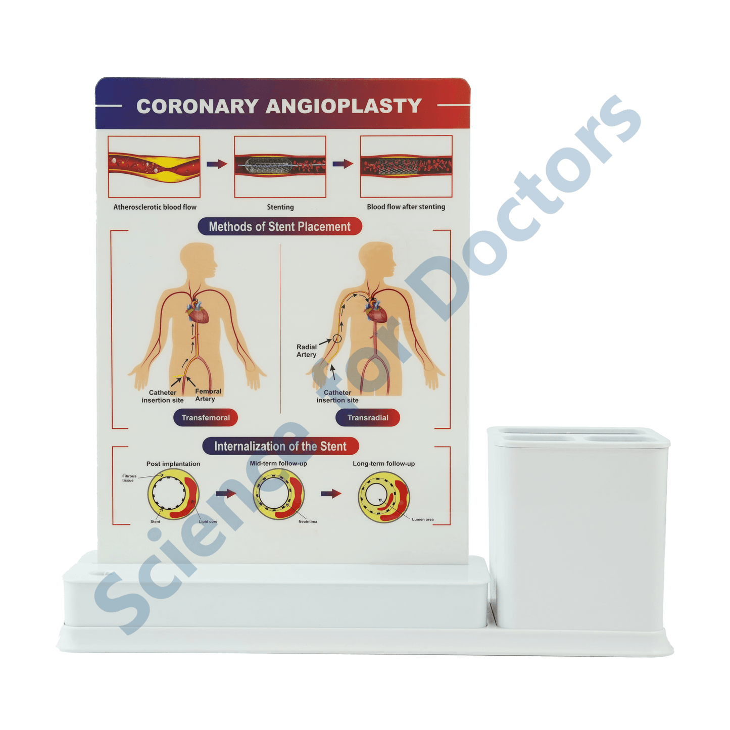 Coronary Angioplasty: 1 Slides Write & Wipe with Stationary Stand