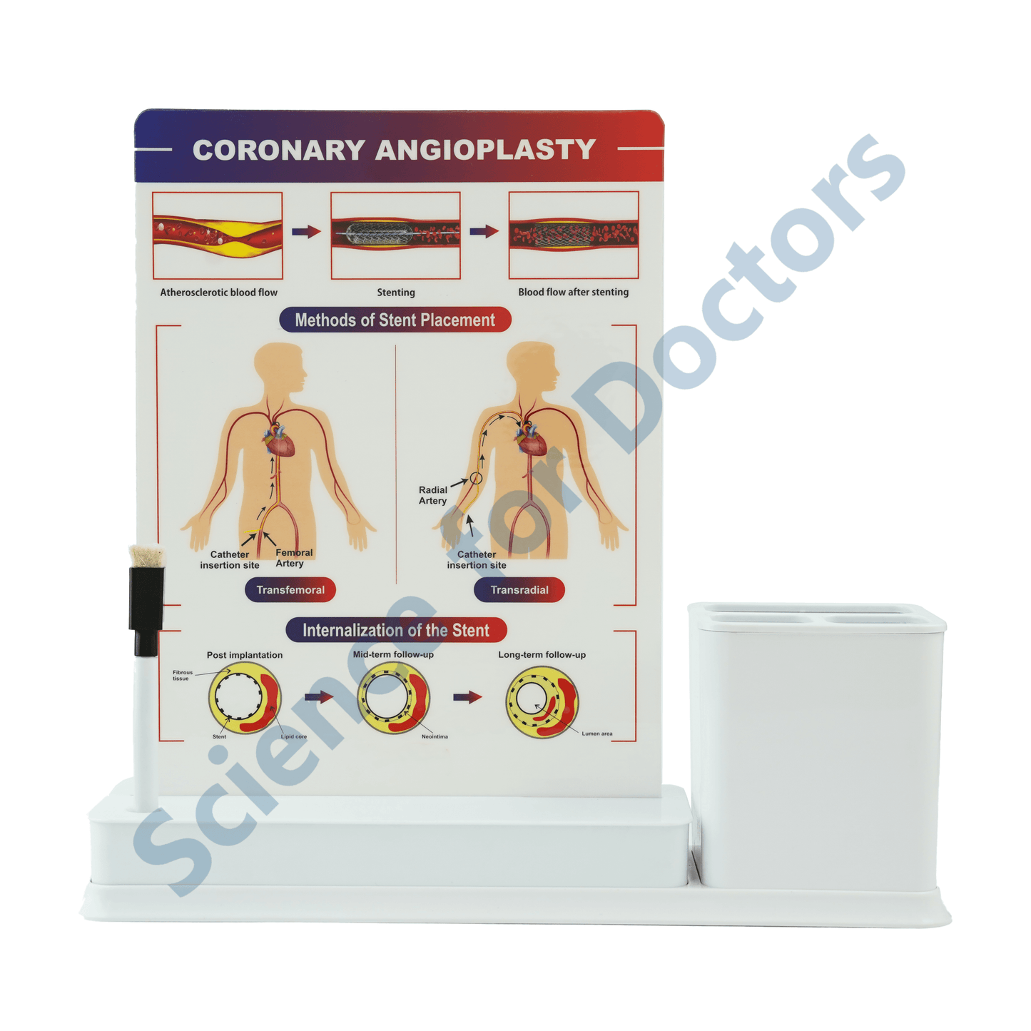 Coronary Angioplasty: 1 Slides Write & Wipe with Stationary Stand