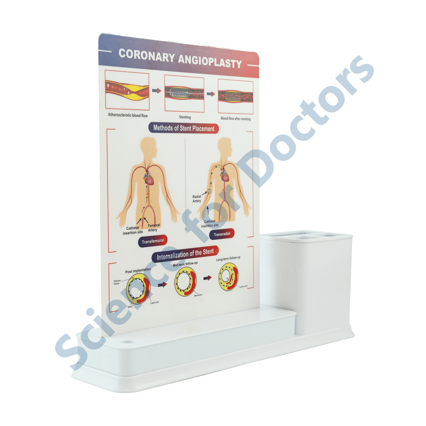 Coronary Angioplasty: 1 Slides Write & Wipe with Stationary Stand