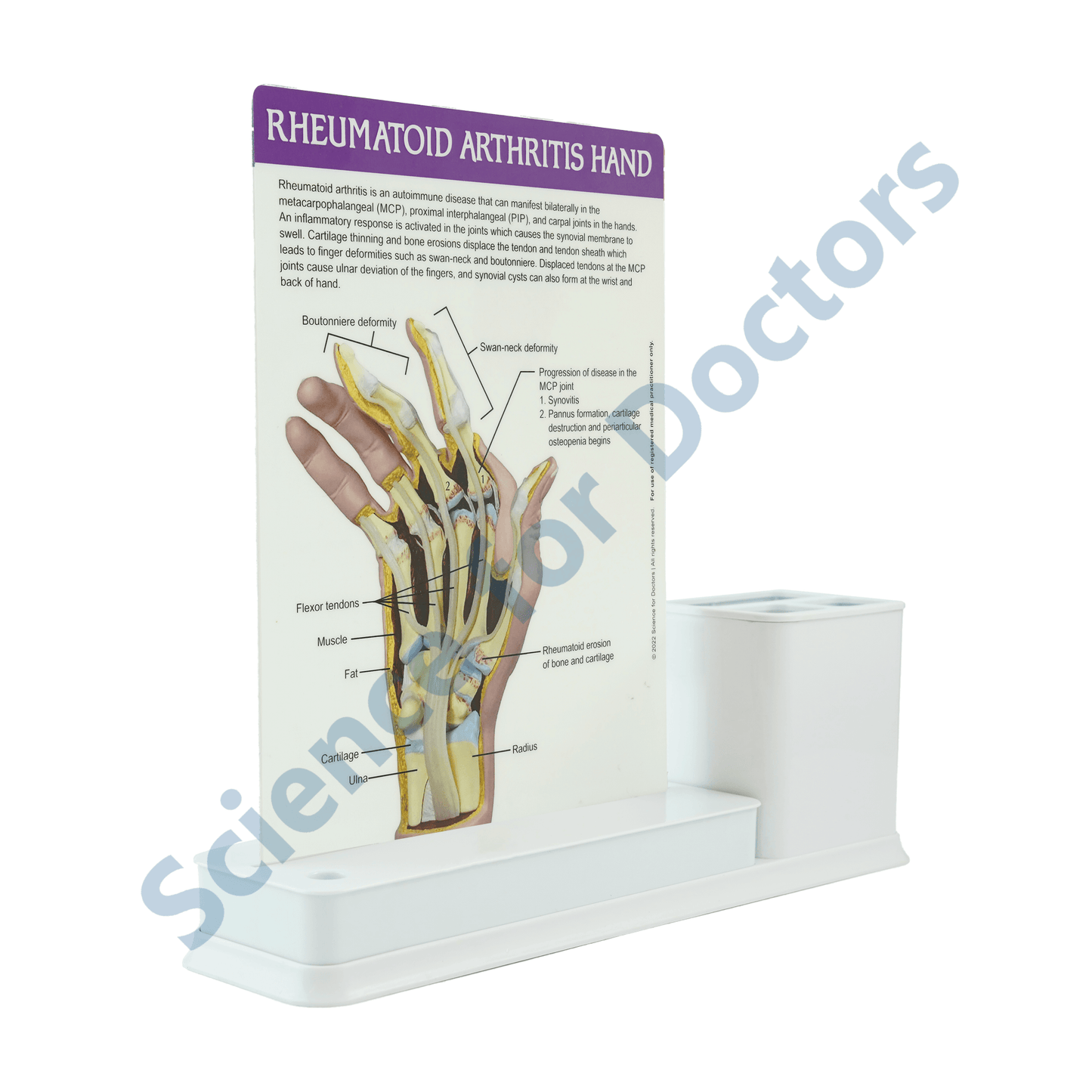 Rheumatoid Arthritis Hand: 1 Slides Write & Wipe with Stationary Stand