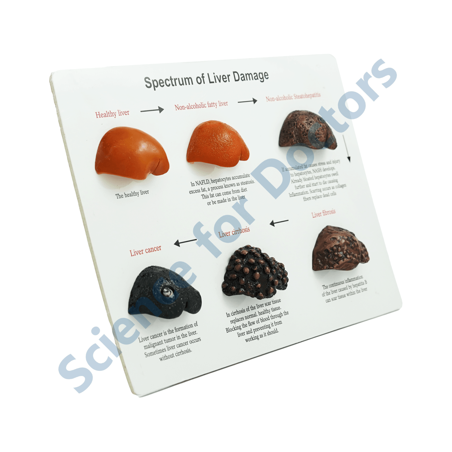 Spectrum of Liver Damage: 3d therapy Board