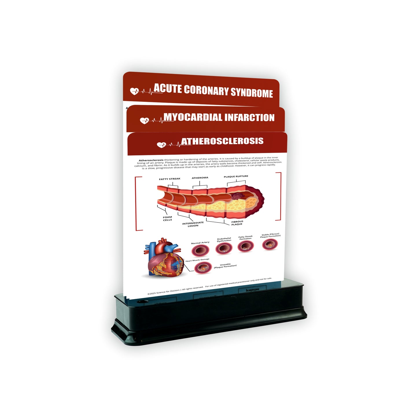 Atherosclerosis: 3 Slides on Stand