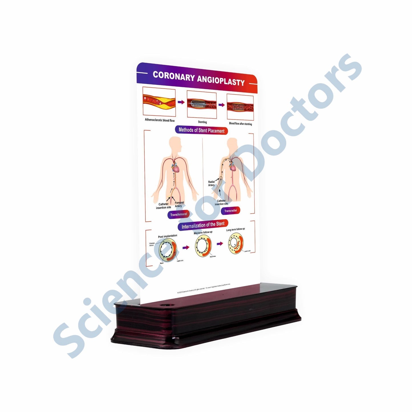 Coronary Angioplasty: 1 Slide on stand