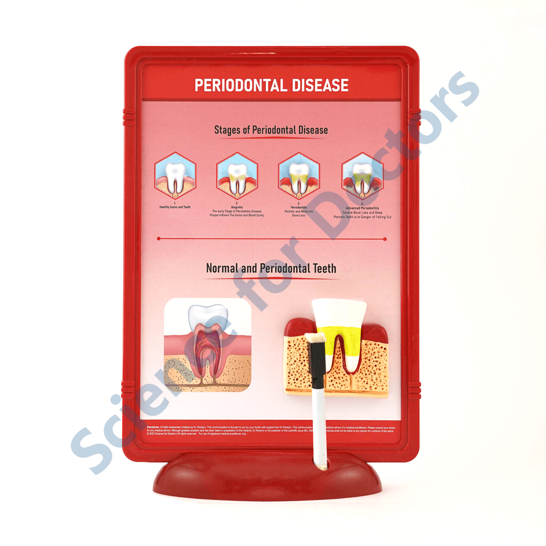 Periodontal Disease: 3D Therapy Frame