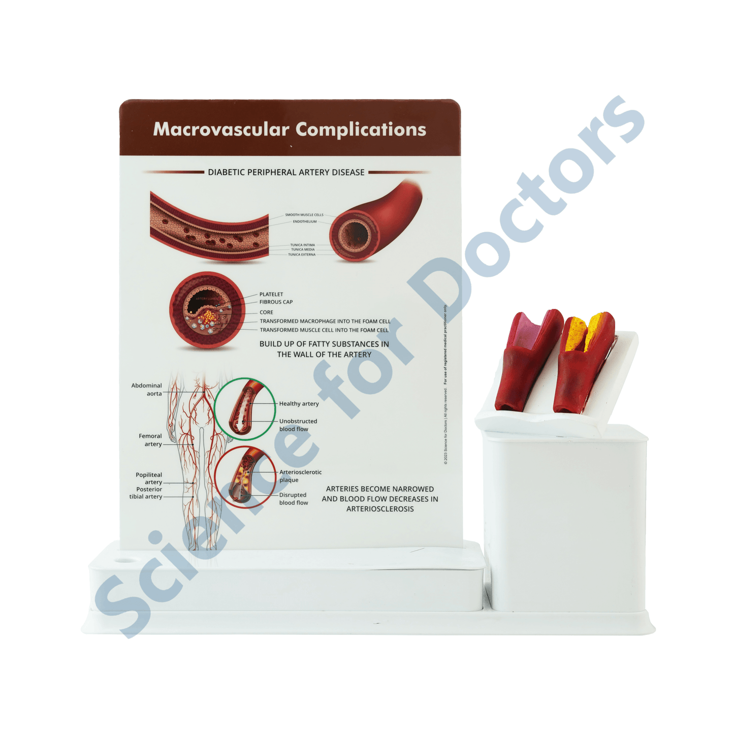 Macrovascular Complications Diabetic Peripheral Artery Disease : 1 Slide write and wipe with anatomical model on stand