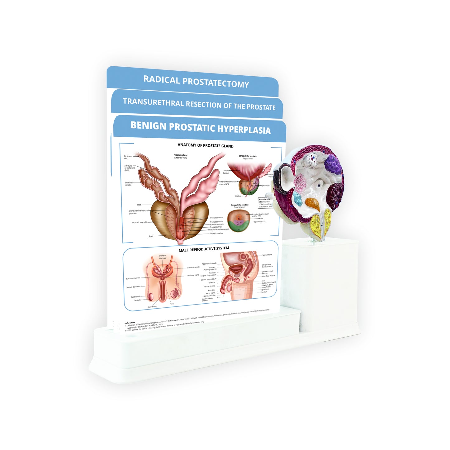 Benign Prostatic Hyperplasia : 3 Slides Write & Wipe With Model On Stand