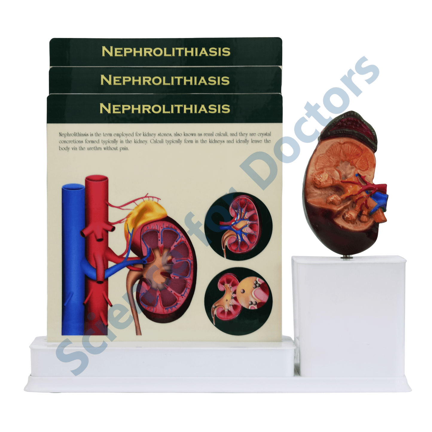 Nephrolithiasis : 3 Slide Write and Wipe with Anatomical Model on Stand