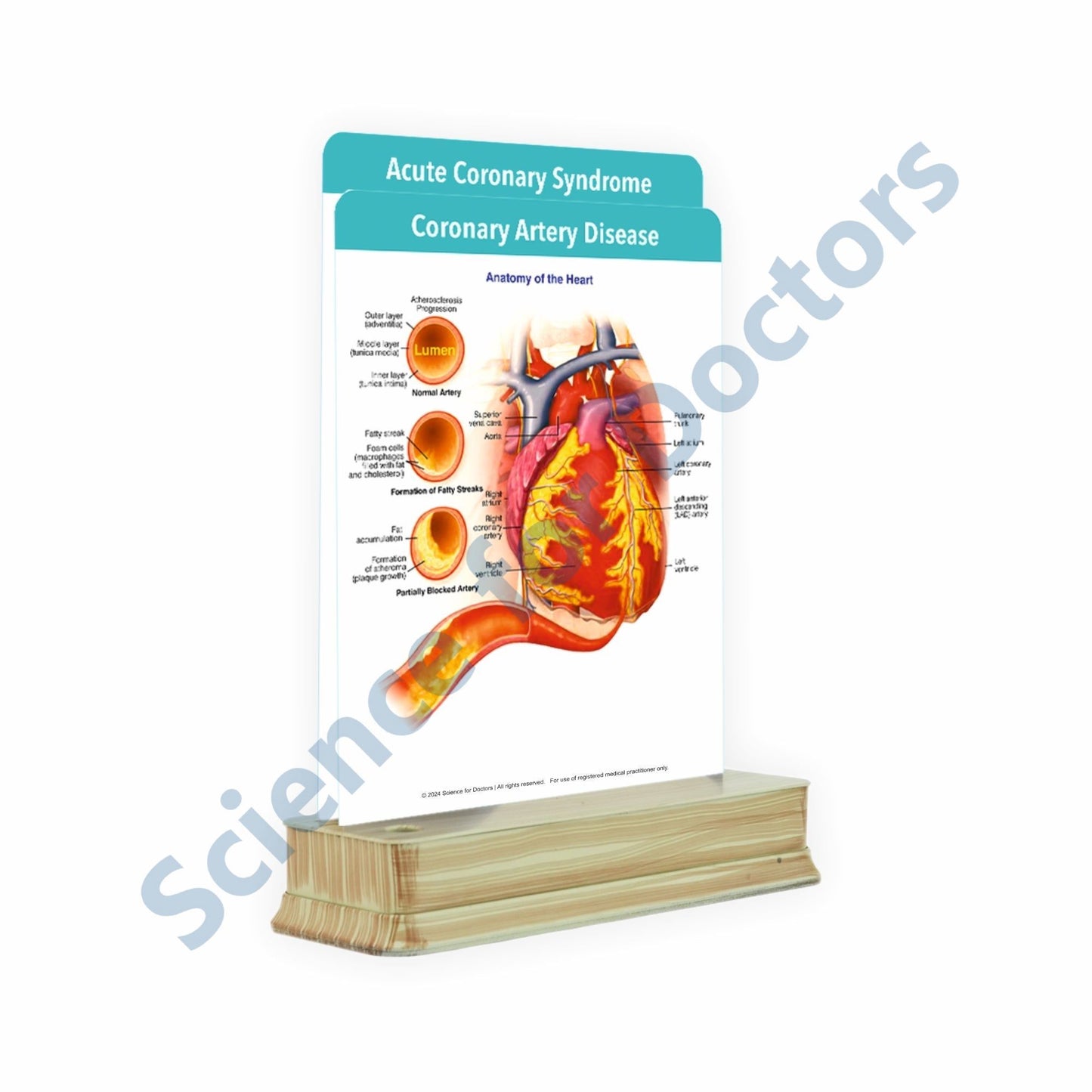 Coronary Artery Disease: 2 slide on stand