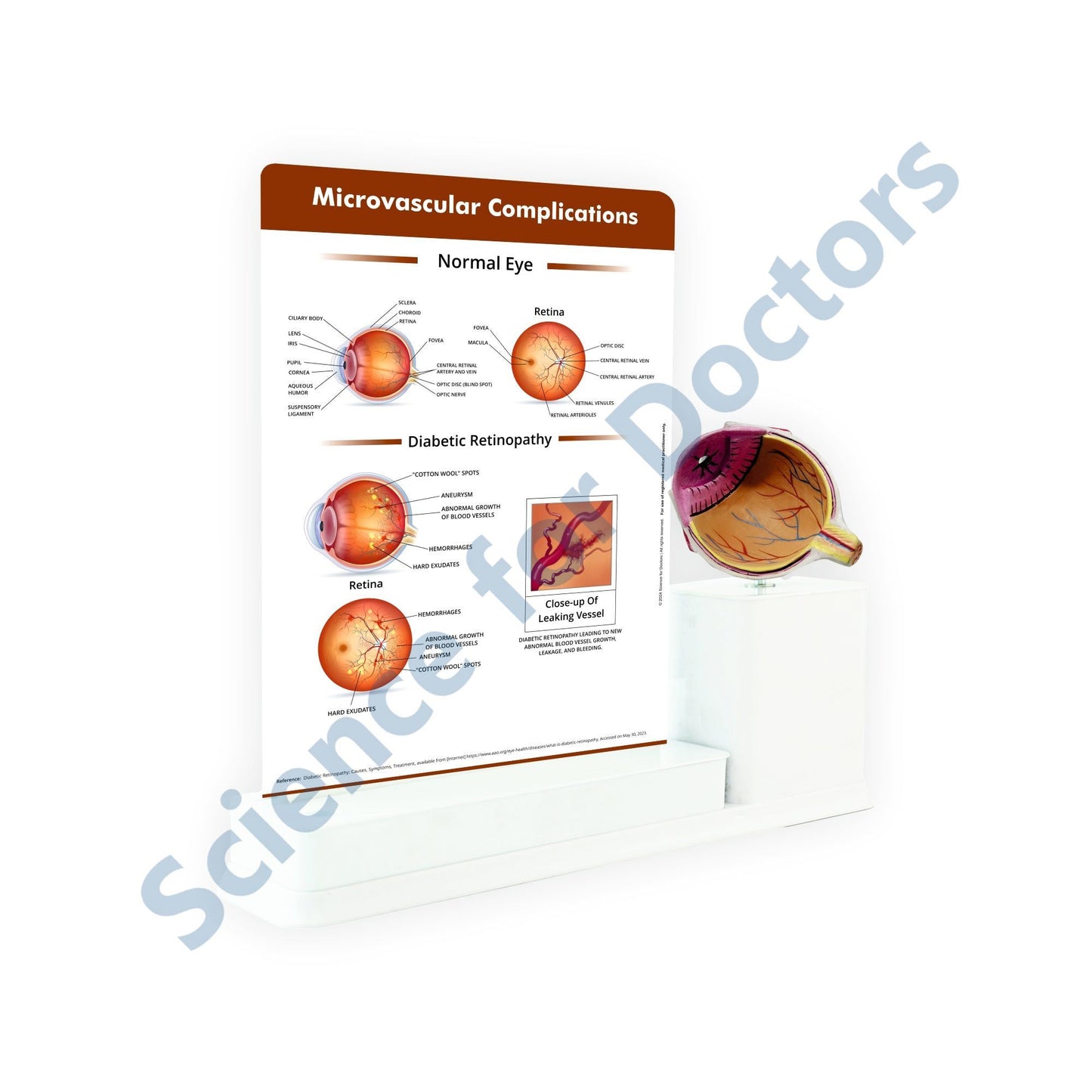 Microvascular complications - Diabetic retinopathy: 1 Slide write and wipe with anatomical model on stand